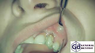 Infiltration anesthesia for treatment tooth 22 [upl. by Basham]