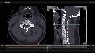 nect ct anatomy aryepiglottic foldscobra fangs analogy [upl. by Berliner]