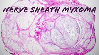 Nerve sheath myxoma with Verocay palisading formerly myxoid neurothekeoma pathology dermpath [upl. by Thoer]