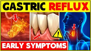 5 Signs And Symptoms Of Gastroesophageal Reflux  Reflux Acid and Gastric Reflux Symptoms  GERD [upl. by Tongue]