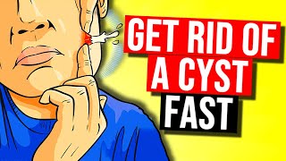 How to Get Rid of a Cyst in 2024 [upl. by Sirah]