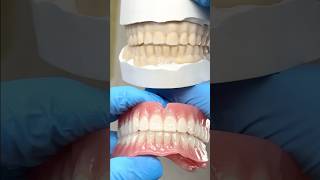 Before and After Dentures EnvisiontecMain envisiontec lsk121shorts dental teeth [upl. by Hahcim961]