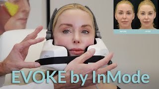 EVOKE by InMode Saggy Skin Treatment Over 50 [upl. by Dickie752]