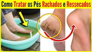 Como Tratar os Pés Rachados e Ressecados [upl. by Landon]