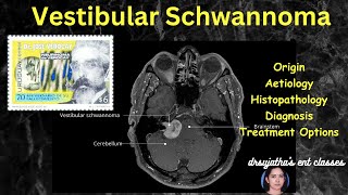 242Vestibular Schwannoma  Acoustic neuroma surgeryeducation [upl. by Rebel]