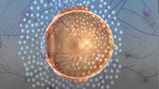 Vitrectomy Surgery for Diabetic Retinopathy [upl. by Eidnac]