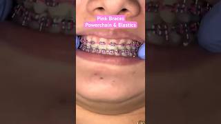 Pink Braces Colors braces bracescolors pinkbraces [upl. by Dlarej]