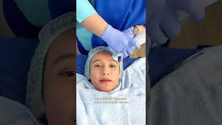 Ipl acne treatment untuk menghilangkan jerawat dan bekas jerawat murah di Bandung [upl. by Hcurob364]