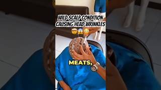 Extra Scalp Skin🥩😫🤮 Wrinkly Heads CVG Explained with Laughs😅 [upl. by Merla786]