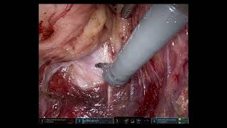 daVinci distal rectal cancer surgery with original audio [upl. by Rem717]