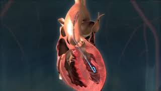 Impella CP® Heart Pump Animation [upl. by Tnert]