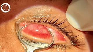 Chalazion surgery [upl. by Coucher]