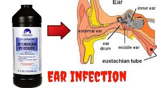 How to Get Rid of an Ear Infection with Hydrogen Peroxide  clickbank review [upl. by Ashli]