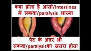 what is INTESTINAL PSEUDO  OBSTRUCTIONPARALYTIC ILEUSOGILVIE SYNDROME [upl. by Iverson]