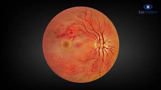 Central Retinal Vein Occlusion CRVO Medication Injection amp Laser Treatment  Free Eye Patient App [upl. by Hale]