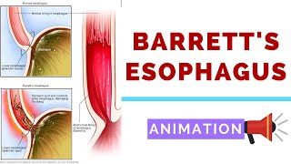 Barretts Esophagus  Pathology Dysplasia and Carcinoma [upl. by Htirehc]