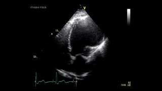 LEFT VENTRICULAR ANEURYSM  ECHOCARDIOGRAPHY [upl. by Enial851]