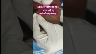 Senile comedones removal by radiofrequency [upl. by Leunamne833]