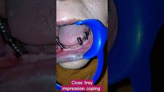 Implant impression using close tray impression coping dentalcafe4331 [upl. by Adiela]