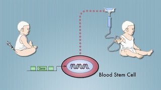 Stem Cell Cure for quotBubble Babyquot Disease SCID Pioneered by UCLAs Don Kohn [upl. by Dorr]