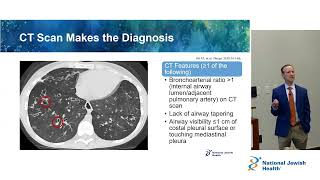 Overview of Bronchiectasis [upl. by Yenar255]