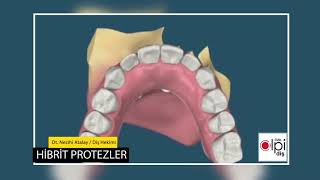 AlpiDiş Hibrit Diş Protezi Nedir [upl. by Geehan900]