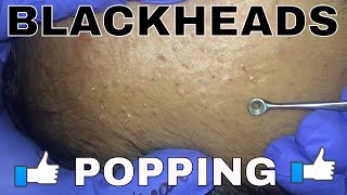 BLACKHEADS POPPING [upl. by Misti]