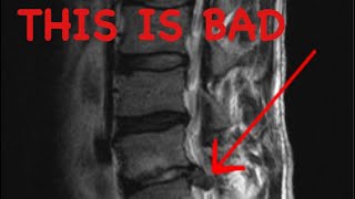 How to Read a Spine MRI [upl. by Jere]