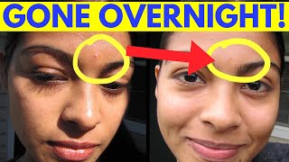 Reduce Pimple Inflammation Overnight [upl. by Llecrup263]