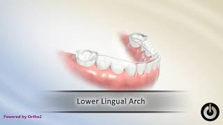 Lower Lingual Arch to Preserve Leeway Space  Dental Braces  Temecula Valley CA [upl. by Lewej]