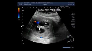 Early first trimester twin Pregnancy  08 weeks [upl. by Cuthburt805]