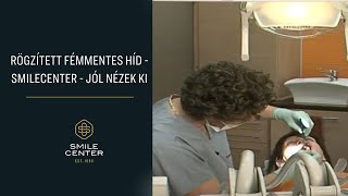 Rögzített fémmentes híd  SmileCenter  Jól nézek ki [upl. by Nottap706]