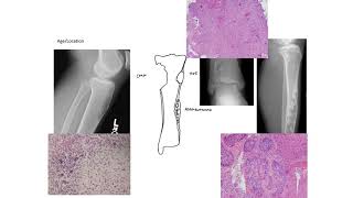 Radiographic assessment of bone tumors voice 1 [upl. by Siocnarf]