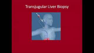 Transjugular Liver Biopsy [upl. by Wamsley]