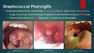 Streptococcal Pharyngitis [upl. by Ennaillij348]