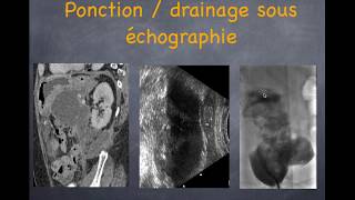 Pancréatite aiguë  3 Diagnostic des complications [upl. by Ydnor873]