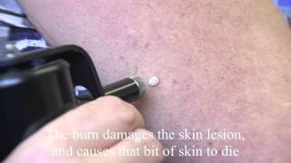 Liquid nitrogen for treating skin lesions [upl. by Hobey]