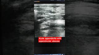 Acute appendicitis with appendicular abscess [upl. by Madalyn515]