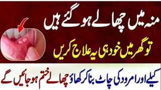 Cure mouth blisters yourself at home remedies Dr Health Officials [upl. by Ahseret618]