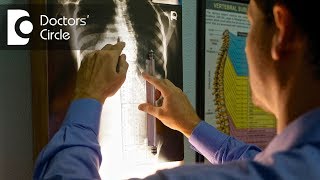 Can a chiropractor treat Scoliosis  Dr Erik W [upl. by Vullo575]