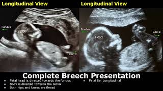 Fetal Presentations Ultrasound Images  CephalicBreechFrankFootlingFunic Fetus  Fetal Lie USG [upl. by Kahn]