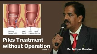 Treatment of Piles without Operation  Part 2 [upl. by Aciret]