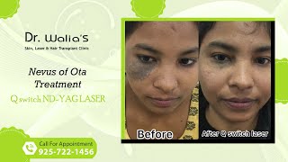 Nevus of Ota Treatment I Qswitch Ndyag laser I Dr Walias Skin and Hair Transplant Clinic [upl. by Annadiane706]