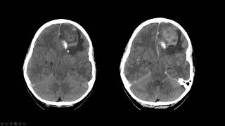 Oligodendroglioma [upl. by Nyra]