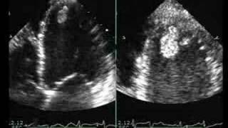 Dilated Cardiomyopathy with Mural Thrombus [upl. by Garner]