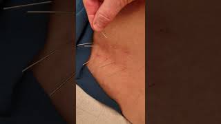 Acupuncture in the lower back for back pain [upl. by Julita832]