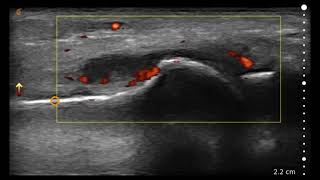 Image Interpretation 1st Metatarsophalangeal MTP [upl. by Wynne]