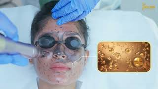 Carbon Laser Facial কার্বনের গুণে দাগহীন ও উজ্জ্বল ত্বকের কার্যকারী সমাধান [upl. by Lesli]