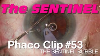 Phaco Clip 53  The Sentinel Bubble [upl. by Roxane]