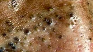 𝐋𝐞𝐚𝐝 𝐀 𝐇𝐚𝐩𝐩𝐲 𝐋𝐢𝐟𝐞𝟗𝟎3  blackheads new this week [upl. by Ihc]